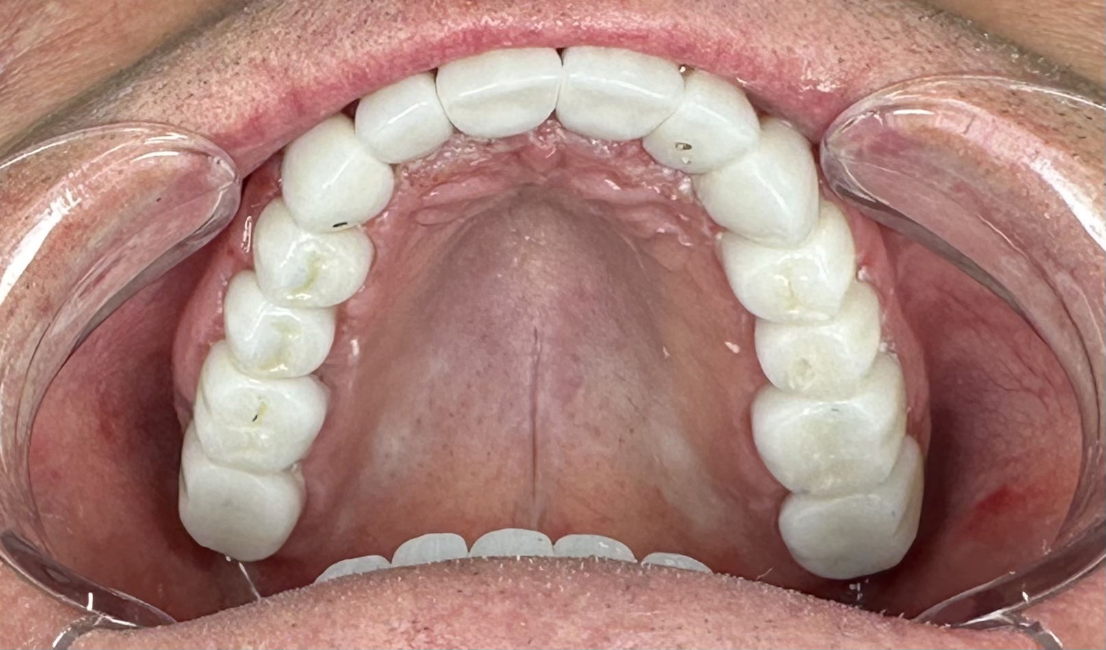Full Mouth Restoration