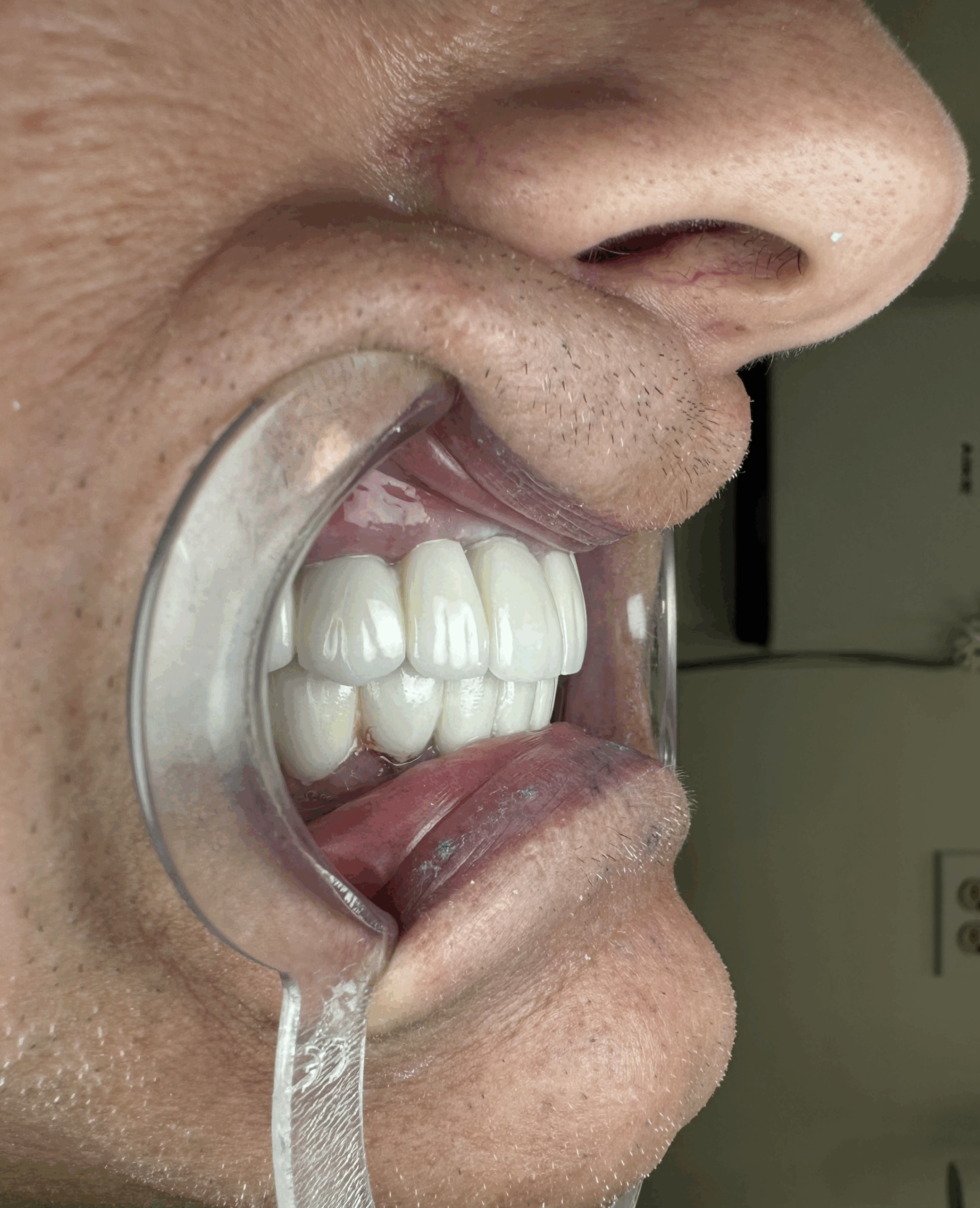 Full Mouth Restoration