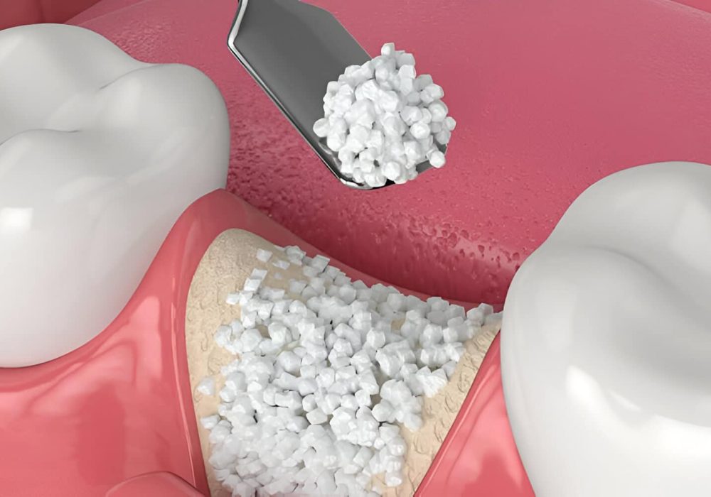 bone-grafting (1)