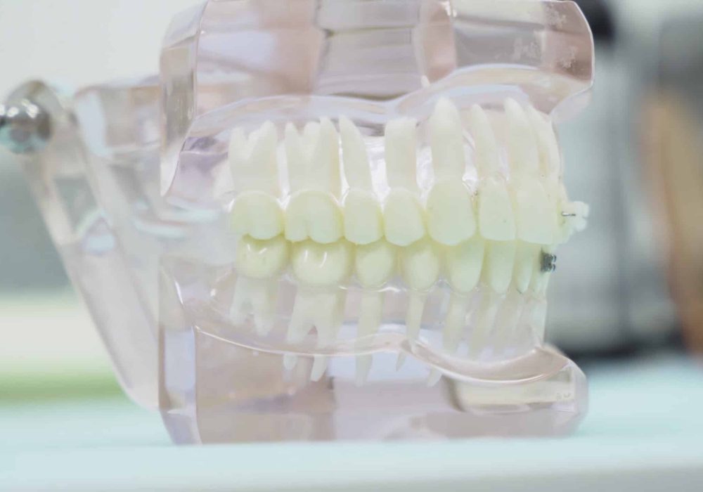 Close-up of denture jaw. Media. Denture of jaws with teeth with transparent gums stands on table in dental office. Modern design of jaw prosthesis.